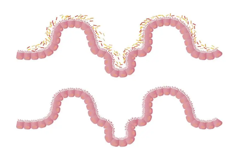 Trapianto di microbiota fecale (FMT)