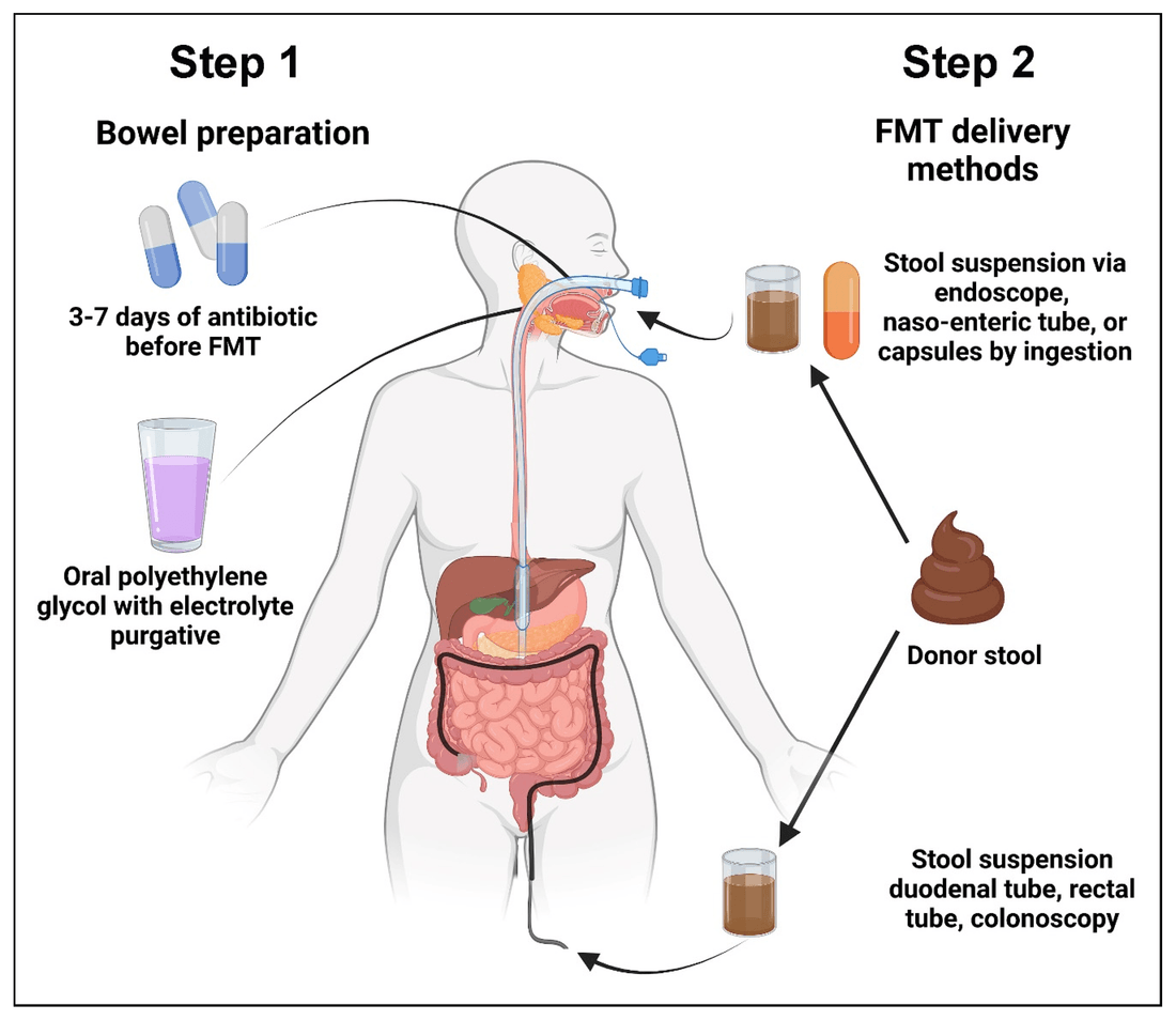 Le due fasi di un trapianto di microbiota fecale: preparazione intestinale e vie di somministrazione dell'FMT
